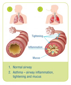 Asthma_airway